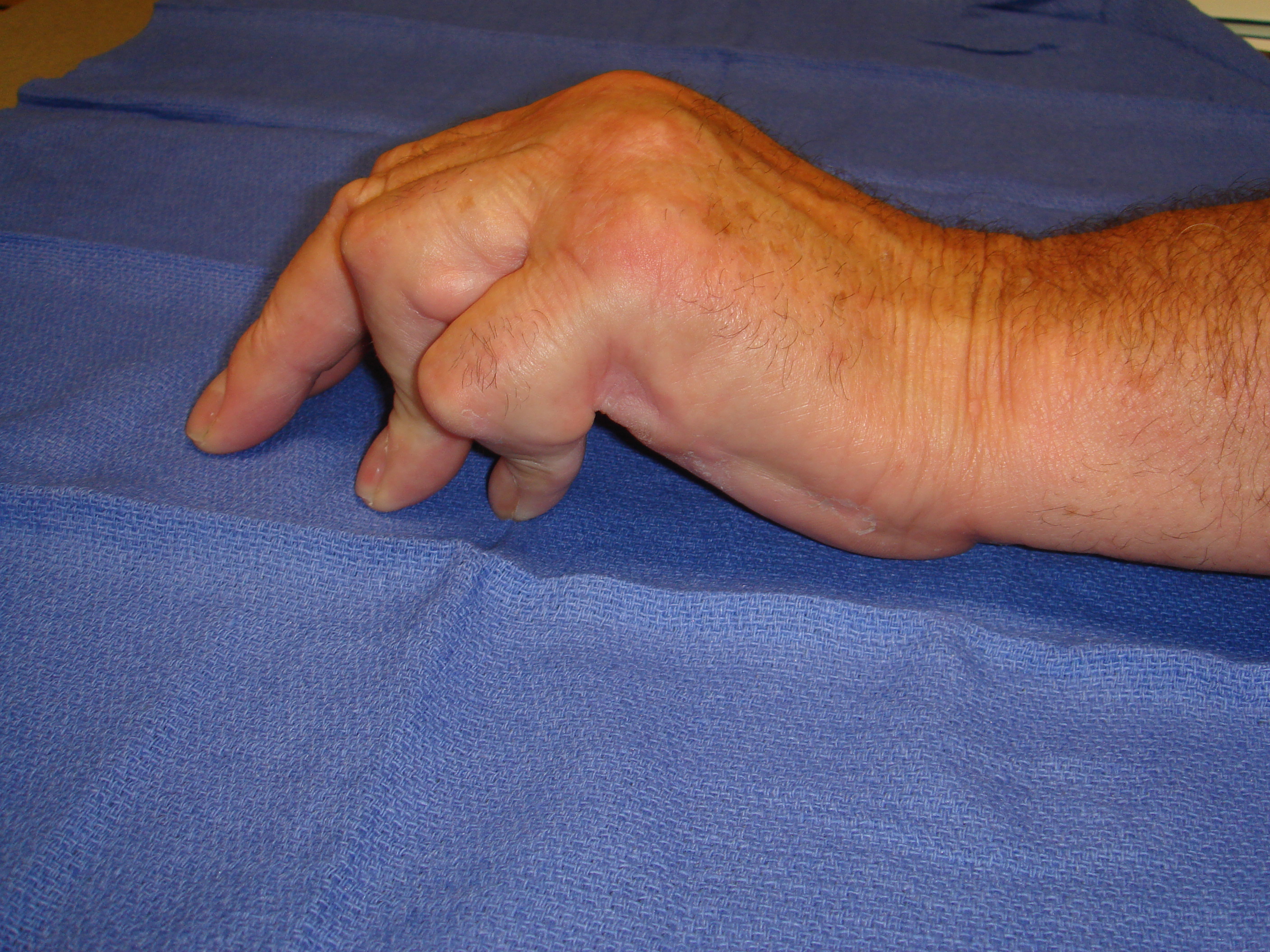 Figure 6a: This patient has advanced post-surgical recurrence of Dupuytren’s contracture affecting his left ring and little fingers. There is very limited active and passive ROM. The patient refused to have surgery again, despite dysfunction, but sought collagenase on the advice of a friend who was treated with CCH. Identifiable, palpable cords are present in addition to scar tissue; ultimately, more than 1 treatment cycle was going to be required; treatment started with the little finger.