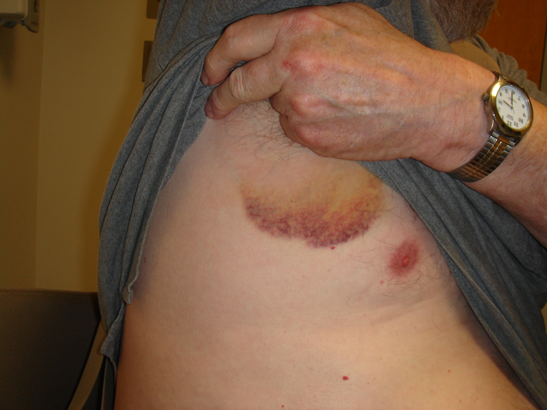 Figure 7c: At the 48-hour visit his right hand is minimally swollen; however, he also has mildly uncomfortable axillary bruising with enlarged nodes.