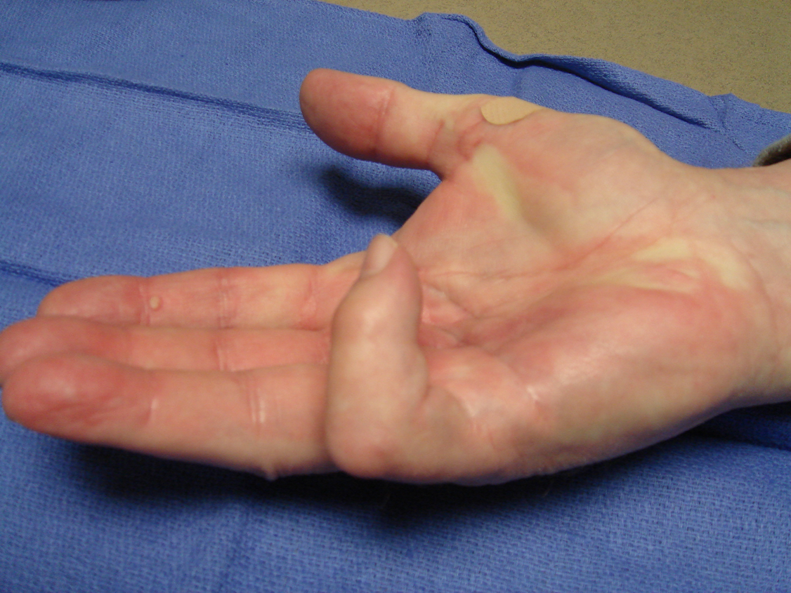 Figure 7d: The right hand 50 days later, with the second cycle of enzyme injection to begin for the little finger PIP and MP recurrence.