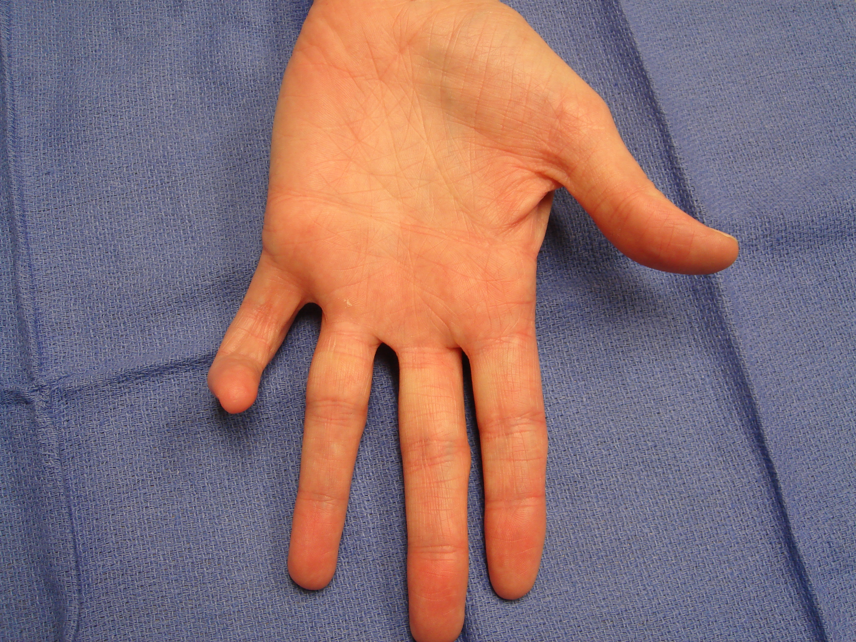 Figure 8b: These images show a woman in her mid-50s with a significant, little-finger, combined (contiguous cord) PIP and DIP contracture. The MP joint was not affected. The injection and manipulation videos depict custom adaptation of the “safe technique” for such an unusual cases.