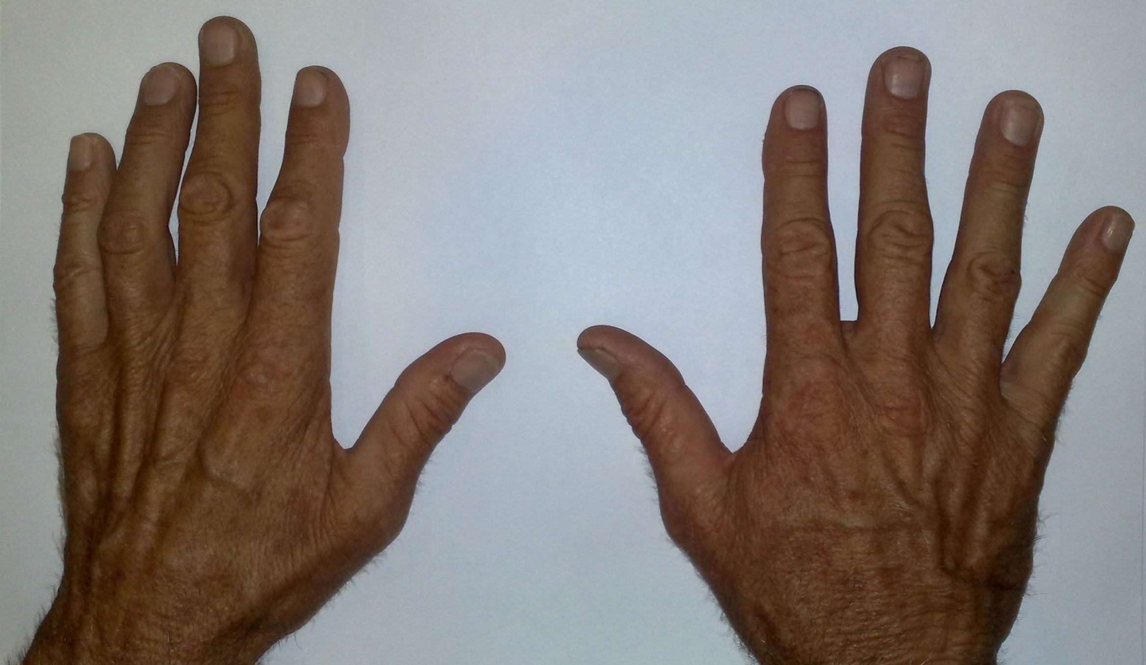 Figure 3a: High ulnar nerve lesion with mild clawing